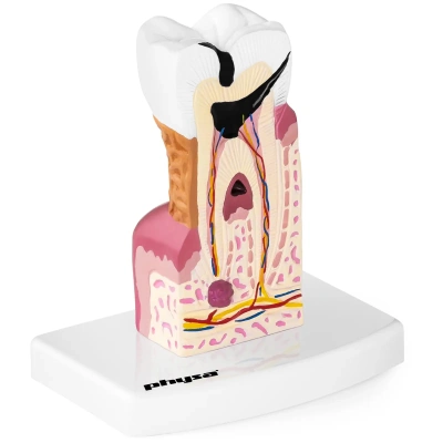 Model nemocného zubu - Anatomické modely physa